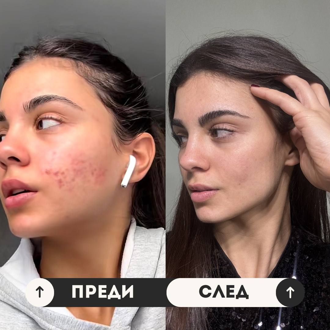 пред и след крема на Vosem